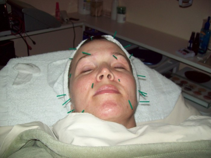 Acupuncture Services I Century City, Los Angeles, Culver City, West ...